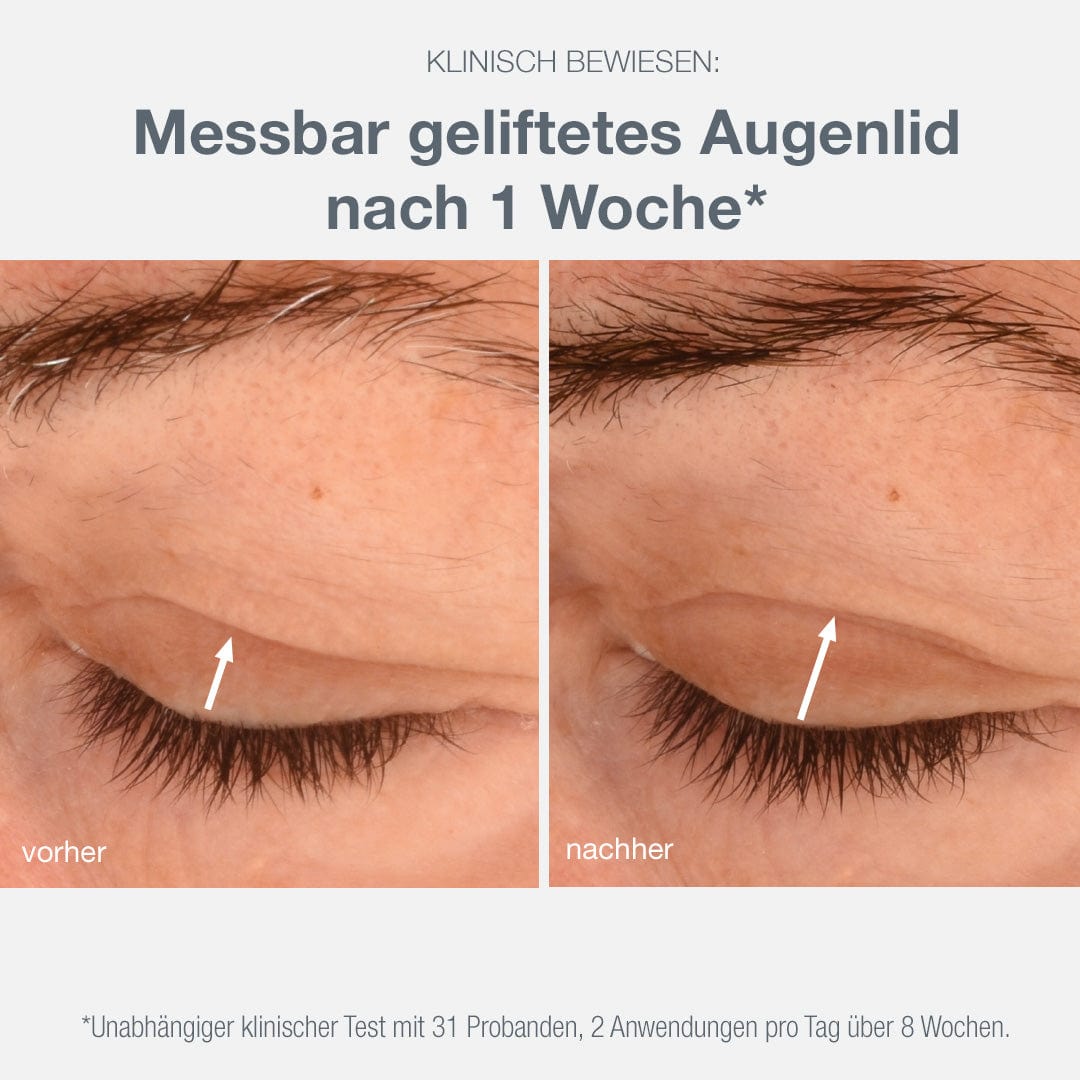 Vorher- und Nachher-Nahaufnahmen eines Augenlids, die die Hautstruktur einer Phyto Nature Lifting Eye Cream nach einer Woche Behandlung zeigen.