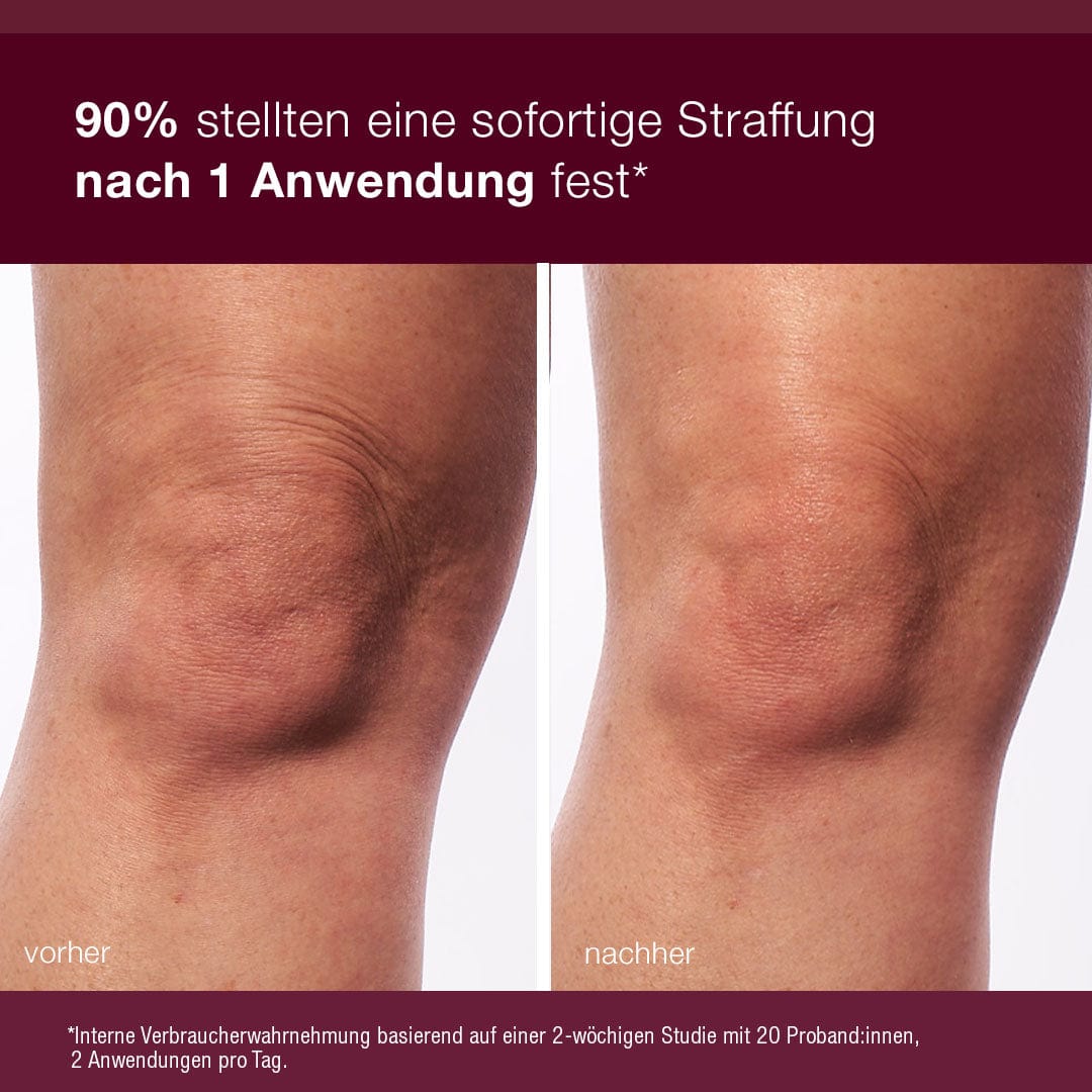 Nahaufnahme eines Knies mit der Aufschrift "vorher" und "nachher", die eine sichtbar glattere Haut nach der Anwendung von Dynamic Skin Sculptor zeigt.