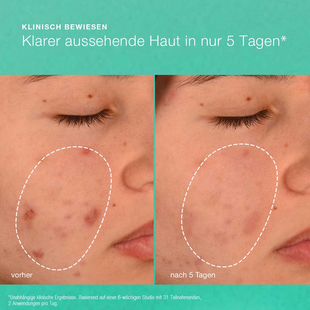 Ein Vergleich der Wangen zeigt weniger Unreinheiten und eine klarere Haut nach 5 Tagen der Anwendung von Breakout Biotic Moisturizer; links vor der Anwendung, rechts nach 5 Tagen.