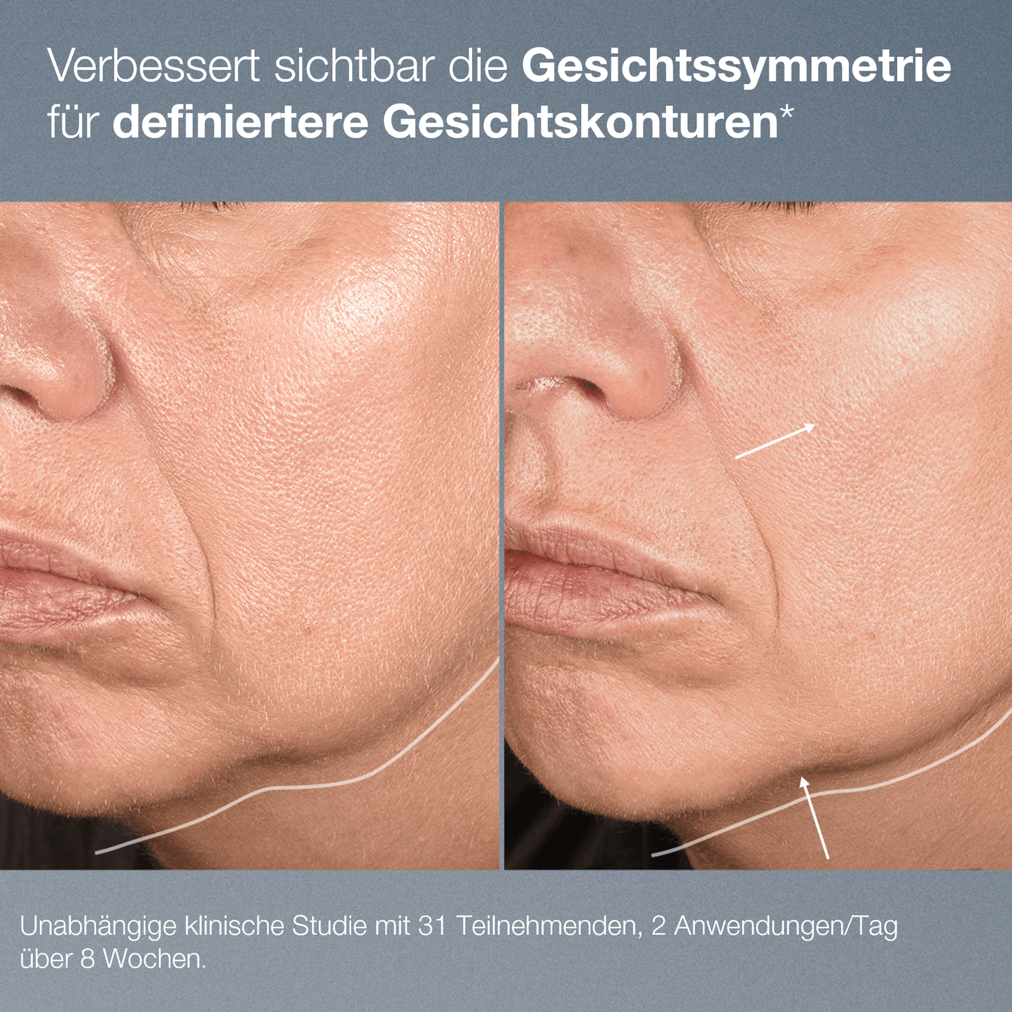 Der Nahvergleich des unteren Gesichts einer Frau vor und nach dem NeuroTouch Symmetry Serum zeigt eine glattere Hautstruktur und weniger Falten. Der deutsche Text hebt die klinischen Ergebnisse und die Vorteile für die Gesichtskonturen hervor.