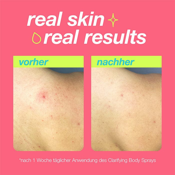 Zwei nebeneinanderstehende Bilder einer Hautpartie zeigen eine Verbesserung der Haut nach einer Woche Anwendung des Clarifying Body Sprays.