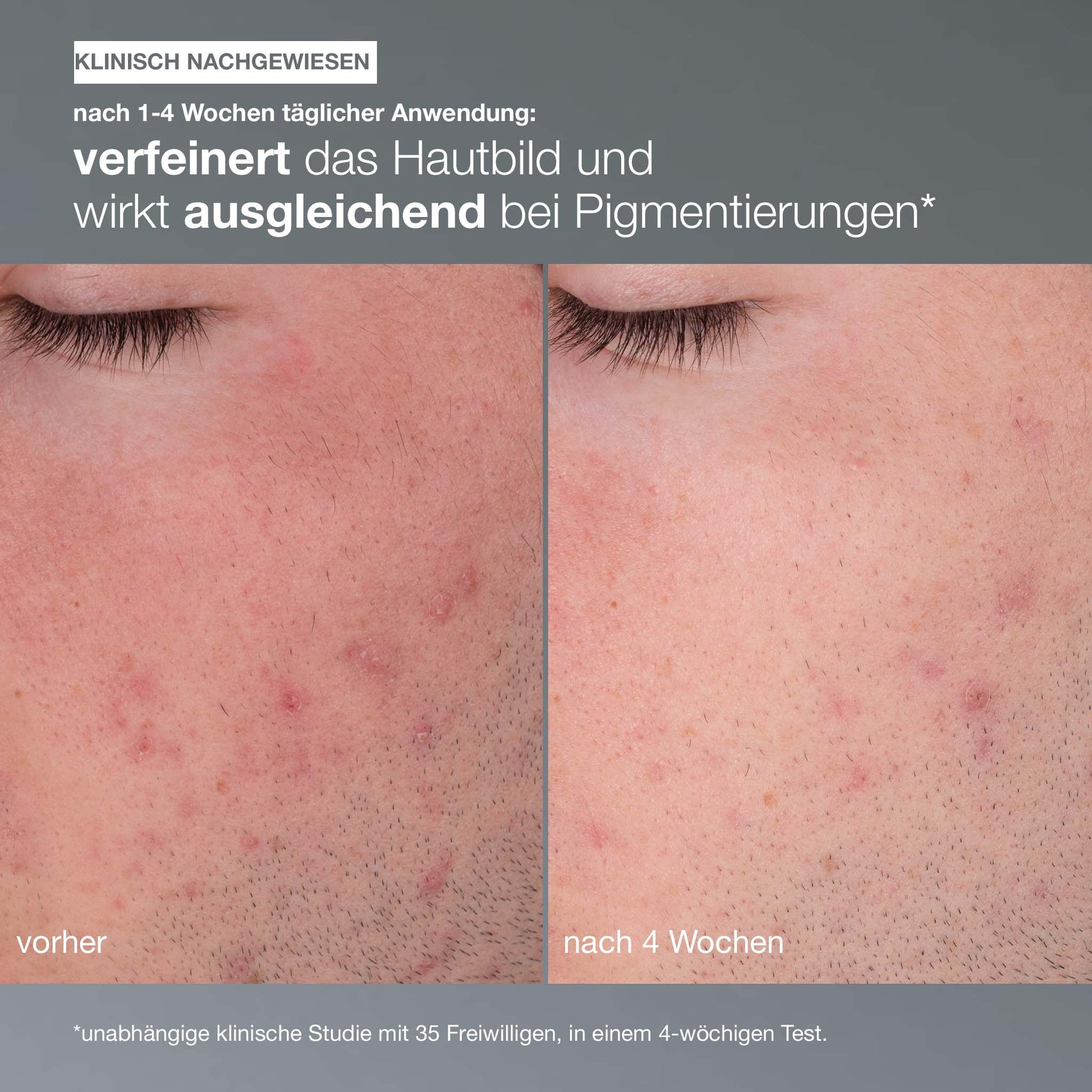 Vergleich der Gesichtshaut vor und nach 4 Wochen täglicher Anwendung von Daily Microfoliant, die Rötungen reduziert und einen strahlenderen Teint zeigt. Der deutsche Text hebt die klinischen Testergebnisse hervor.