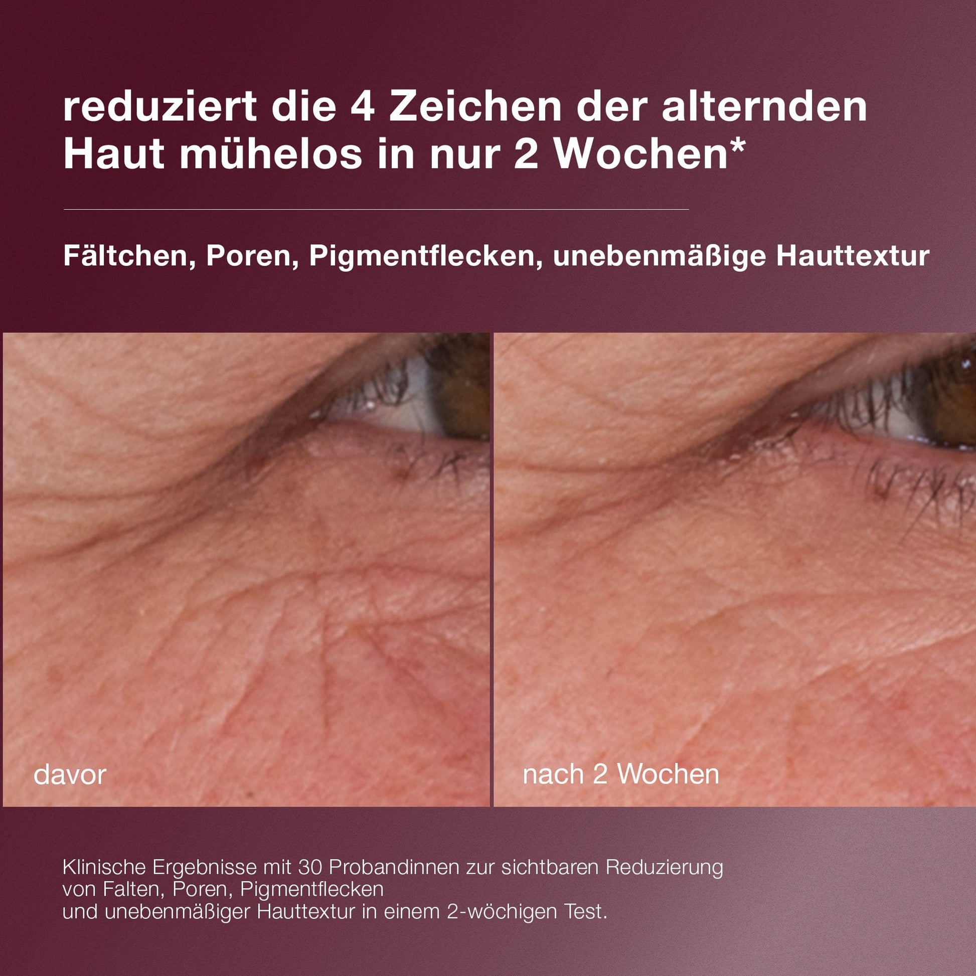 Nahaufnahme der Haut um ein Auge herum, die die Ergebnisse "vor" und "nach 2 Wochen" mit Dynamic Skin Retinol Serum zeigt, wobei die reduzierten Falten und die verbesserte Hautstruktur hervorgehoben werden.