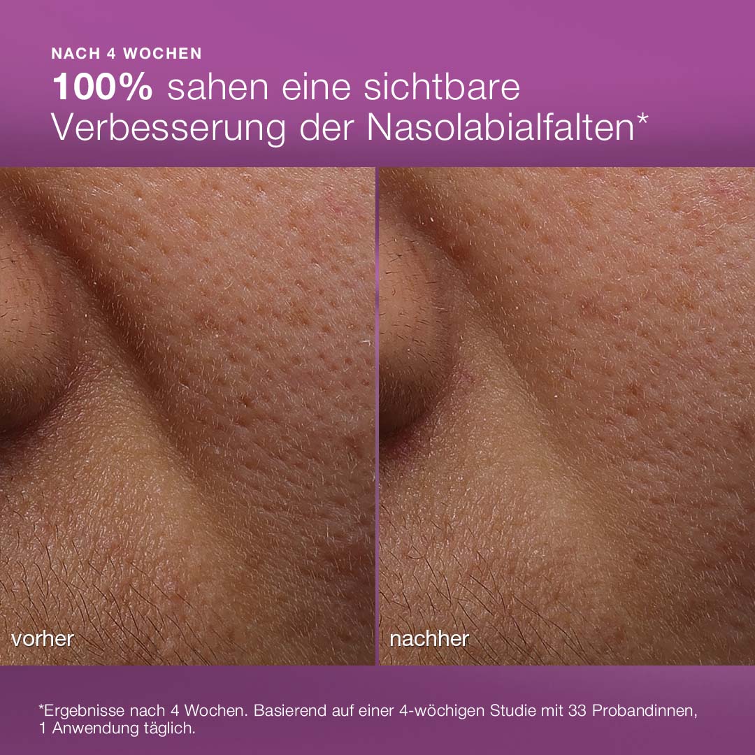 Nahaufnahme der Haut um die Nase und die Lippen mit der Beschriftung "vorher" und "nachher", die die Faltenreduzierung nach der Anwendung der MultiVitamin Power Recovery Cream für beanspruchte Haut zeigt.