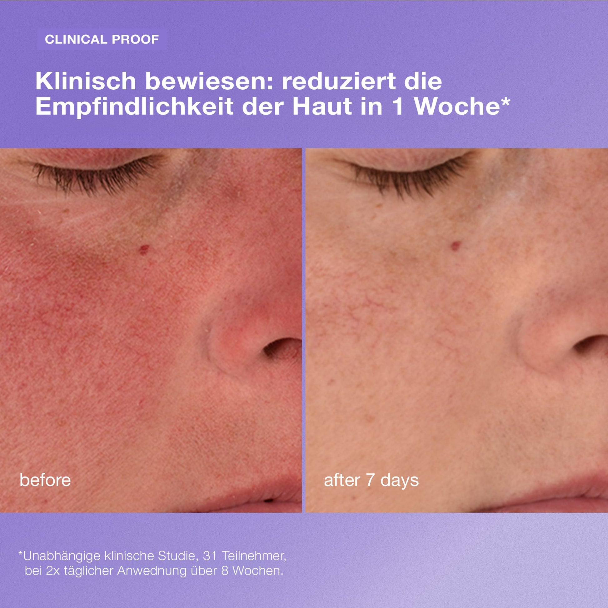 Nahaufnahme der empfindlichen Wangenhaut vor und nach 7 Tagen mit verminderter Rötung und Empfindlichkeit; der deutsche Text hebt die klinisch nachgewiesenen Ergebnisse der Stabilisierenden Reparaturcreme hervor.