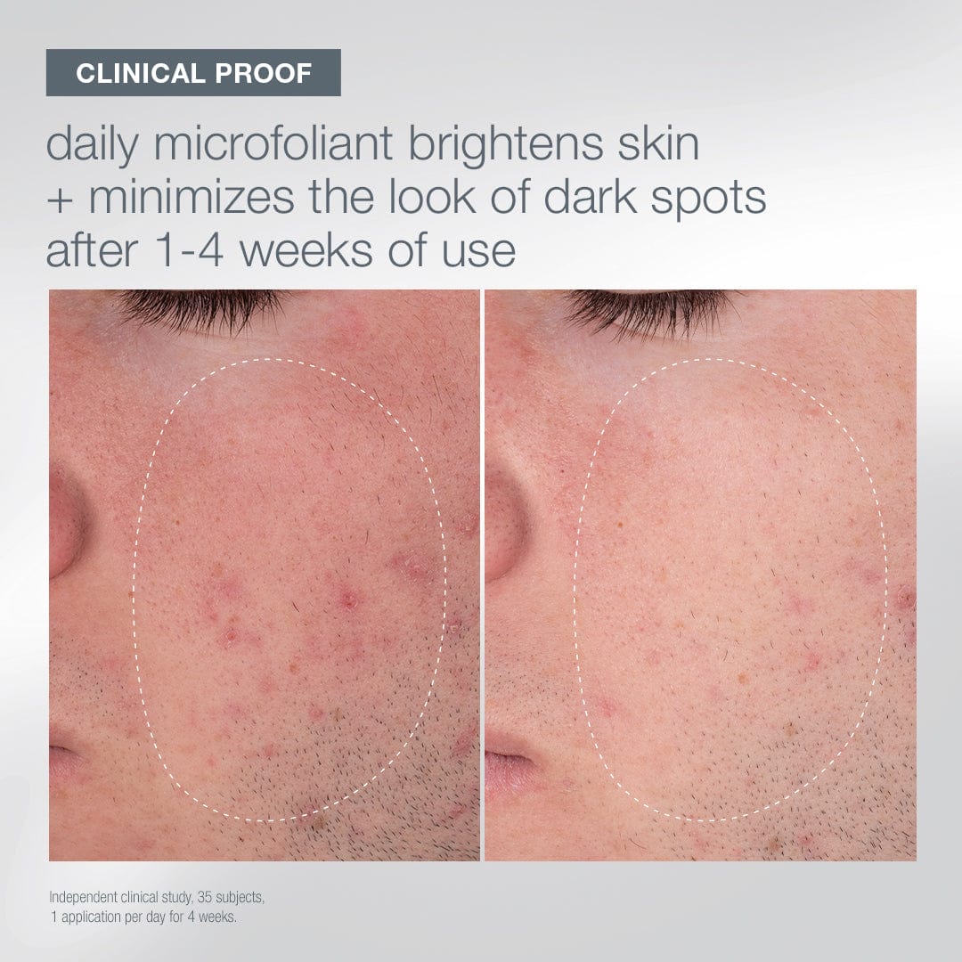 Nahaufnahme der Wange einer Person vor und nach der Anwendung des Let it Glow-Sets, die die Reduzierung dunkler Flecken und eine hellere, gesündere Haut in einem hervorgehobenen Bereich zeigt.